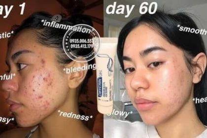 kem-tri-mun-differin-gel-acne-treatment-0-1-tuyp-15g9