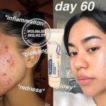 kem-tri-mun-differin-gel-acne-treatment-0-1-tuyp-15g9